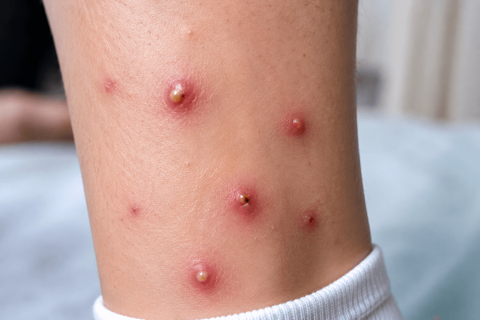 Infected Insect Bite Symptoms