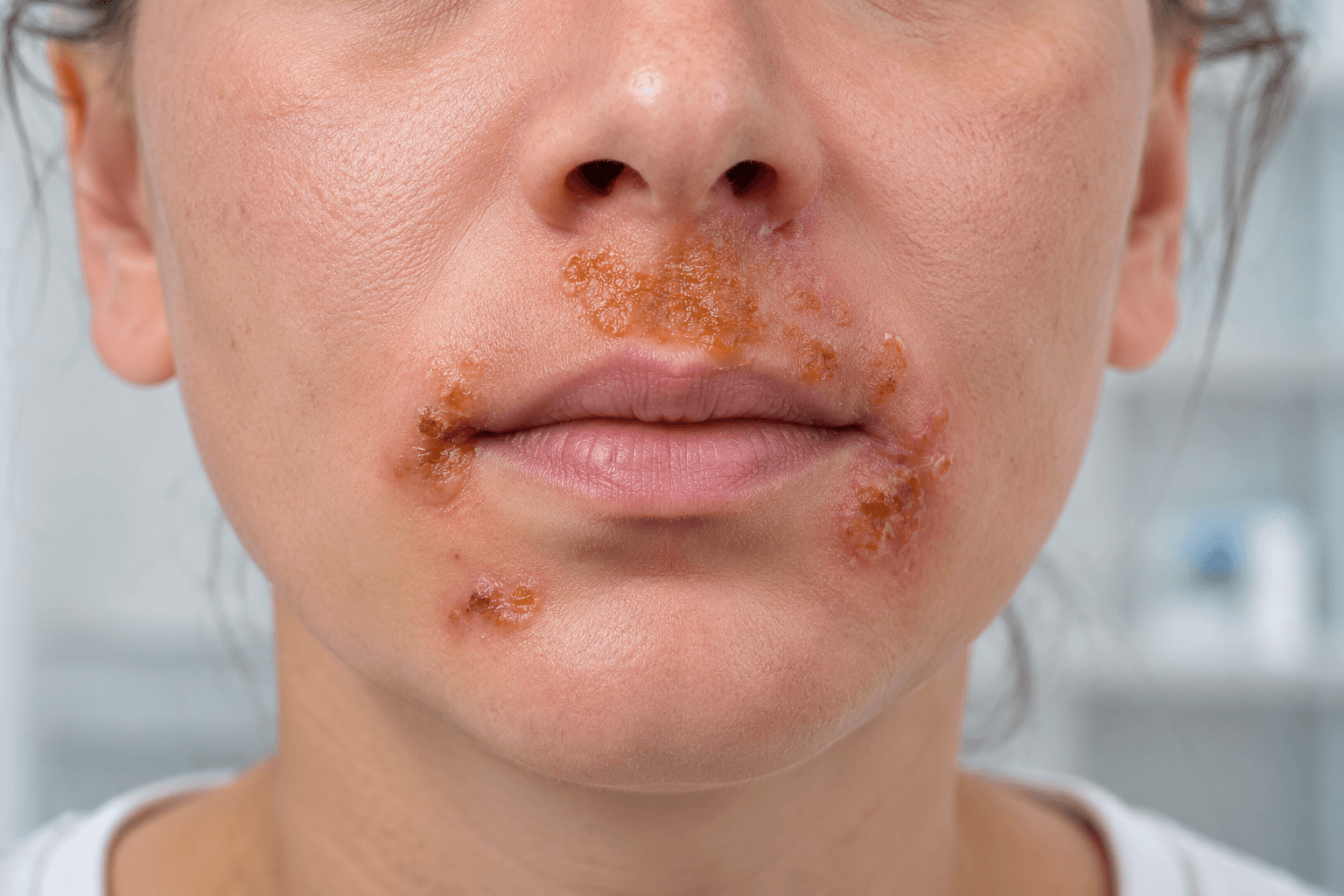 Impetigo Symptoms