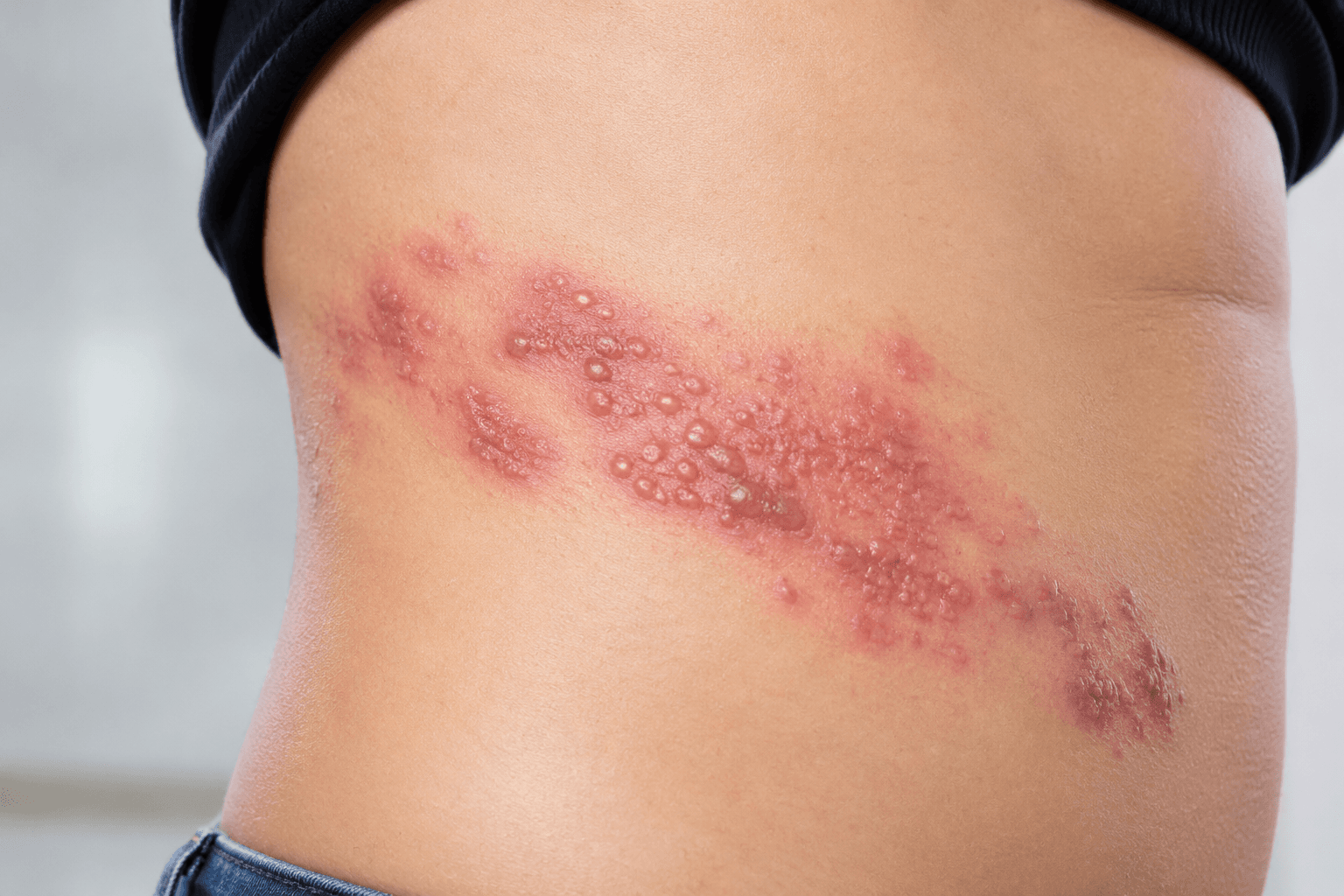 Shingles Symptoms
